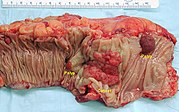 Gross appearance of a colectomy specimen containing two adenomatous polyps (the brownish oval tumors above the labels, attached to the normal beige lining by a stalk) and one invasive colorectal carcinoma (the crater-like, reddish, irregularly shaped tumor located above the label).