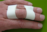 "Buddy Taping" bei Verletzung des ulnaren Seitenbandes am Mittelfinger oder des radialen am Ringfinger.