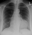 Perikarditli bir kişide CXR'de görüldüğü gibi perikardiyal efüzyon