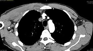 CT with IV contrast showing enlargement and heterogeneous hypodensity in the right pectoralis major muscle. A focal abscess collection with gas within it is present medially. There are enlarged axillary lymph nodes and some extension into the right hemithorax. Note the soft tissue and phlegmon surrounding the right internal mammary artery and vein. The patient was HIV+ and the pyomyositis is believed to be due to direct inoculation of the muscle related to parenteral drug abuse. The patient admitted to being a "pocket shooter"