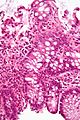 Micrograph showing crypt inflammation. H&E stain.
