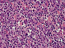 Cutaneous diffuse large B-cell lymphoma (DLBCL)