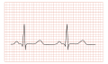 Normal ECG 2