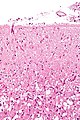 Micrograph of the superficial cerebral cortex showing neuron loss and reactive astrocytes in a person that has had a stroke. H&E-LFB stain.