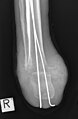 Röntgenaufnahme AP nach tibio-kalkanearer Arthrodese (Pirogoff)