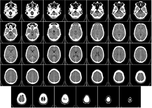 Bilgisayar tomografisiyle beyin