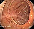 Normaler Blinddarm mit Bauhinscher Klappe (Colon ascendens)