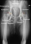 Röntgenaufnahme einer HD beim Hund. Der Femurkopf ist bereits subluxiert, das Acetabulum (Hüftgelenkspfanne) umgreift ihn nicht mehr.