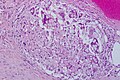 Fadengranulom: chirurgisches Nahtmaterial und mehrkernige Riesenzellen