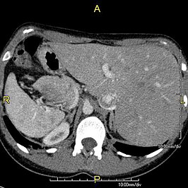 Axiale CT van een situs inversus bij PCD. De afbeelding wordt van onderaf bekeken, met links (rechts op de afbeelding) de lever en de vena cava inferior en rechts de milt en de aorta.