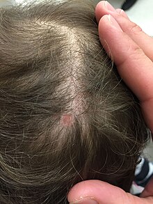 Circular, hairless area of atrophy on the scalp vertex