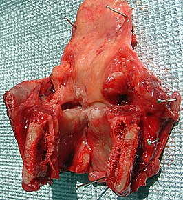 Larynxcarcinoom