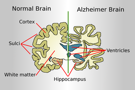 The working of Alzheimer