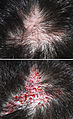Haartransplantation, vor und nach der Graftsverpflanzung auf eine Akne-inversa-Narbe. (2008 mit Nikon D40x)