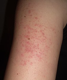 Keratosis pilaris on arm