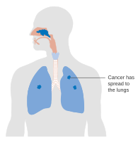 Diagram showing nasal cavity cancer that has spread to the lungs