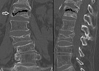 Intravertebral vacuum cleft sign