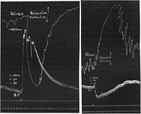 Adrenaline reversal after Henry Hallett Dale (1906). An ergot extract was injected between left-hand and right-hand tracings.