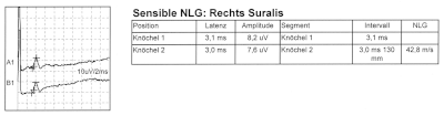 Normale sensible Neurographie am N. suralis