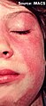 Malar and facial erythema, perioral sparing.