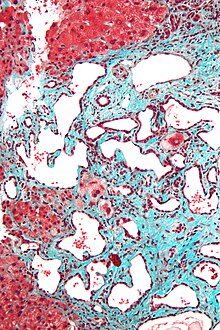 Micrograph of a bile duct hamartoma. Trichrome stain. Intermediate magnification