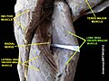 Der N. radialis schlingt sich zwischen dem Caput longum und dem Caput laterale des Triceps brachii hindurch.