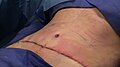 Completely sutured incision from abdominoplasty