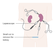 Small incisions with a camera.