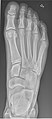 Right foot, dorsoplantar