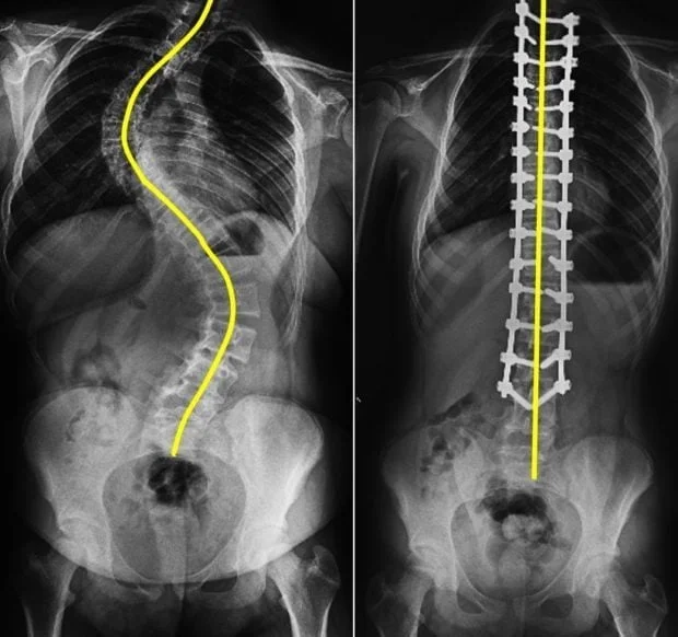 File:Scoliosis-mehmetnurierdem.webp