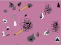 This image shows the the microscopic signs of alzheimer's disease on the brain. Alzheimer's forms plaques (clumps of protein fragments), and tangles (twisted strands of protein). You can find plaque In point A. In point B, you will see the tangles that have formed inside dying cells.