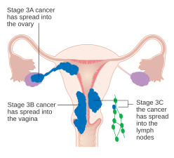 A diagram of stage III endometrial cancer