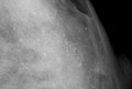 Beispielbild: Mikrokalkablagerungen in einer weiblichen Brust (Mammografie-Aufnahme)