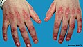 Gottron's papules: erythematous to violaceous raised papules.