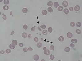 Schizocyten bij een patiënt met het hemolytisch-uremisch syndroom