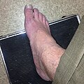 Raynaud's Right Foot