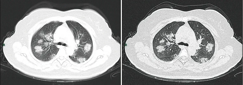 CT-scan van 50-jarige vrouw met COVID-symptomen