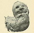 Lithopedion die in 1898 is ontdekt, twee jaar na de mislukte zwangerschap.