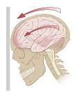 Acceleration (g-kræfter) kan skabe rotationskræfter i hjernen, specielt i midthjernen og diencephalon, og derved forårsage hjernerystelse.