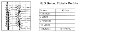 Normale F-Wellen des N. tibialis