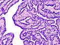 Histopathology of intraductal papilloma of the breast by excisional biopsy. Hematoxylin and eosin stain.