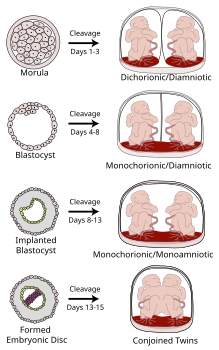 Chorionicity and amnionicity of twins. Attribution 3.0 Unported licensing, attributed to Kevin Dufendach and Mikael Häggström