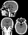 Brain, case 1: Multiplanar, but no intravenous contrast.