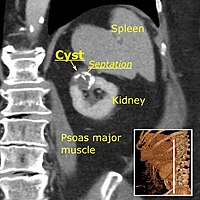 Renal cyst of Bosniak class 2F