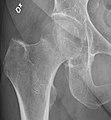 Projectional radiography ("X-ray") shows a subtle subcapital radiodense line