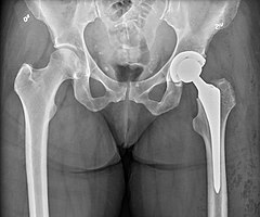 Anteroposterior image of pelvis