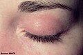 Heliotrope. Confluent macular erythema confined to the upper eyelid, with associated periorbital edema.