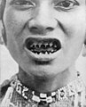 Gefeilte Zähne einer Bagobofrau von der Insel Mindanao (Philippinen)