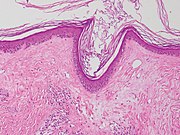 Lichen sclerosus mit follikulärer Hyperkeratose