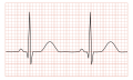 Normal ECG